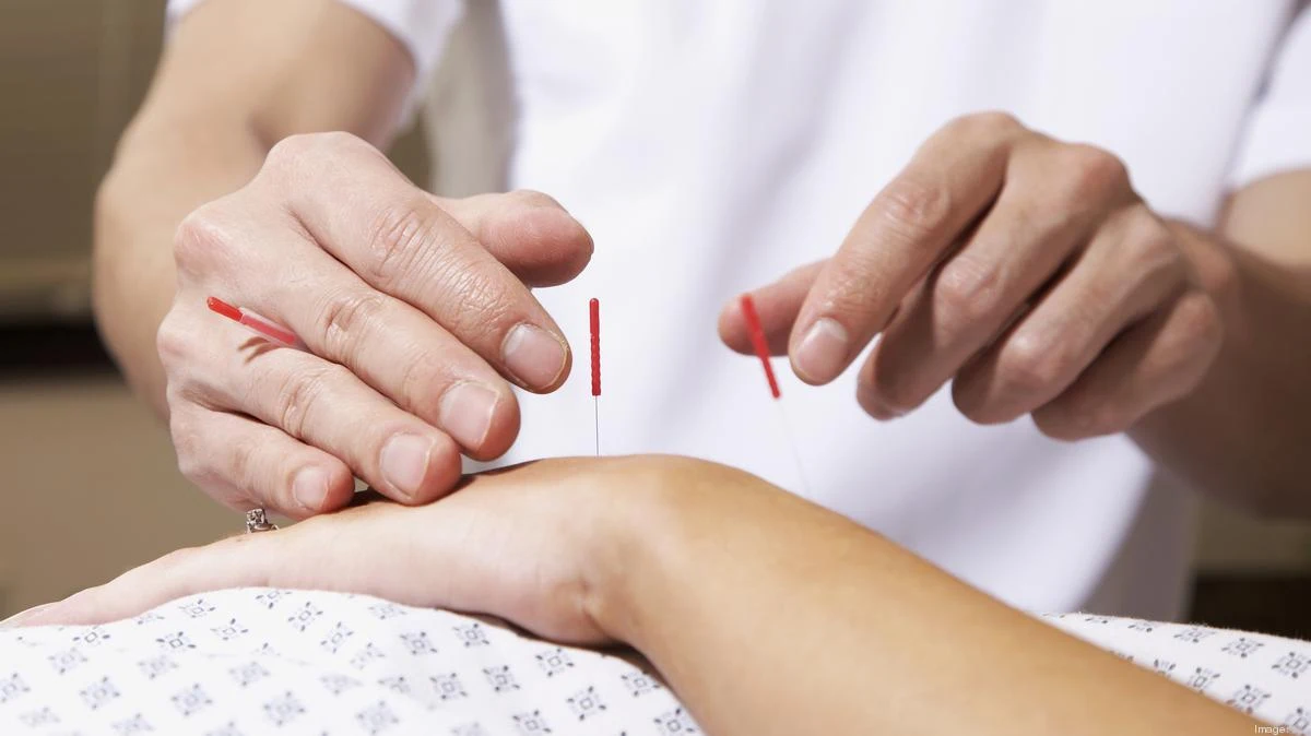 Real Estate Stress Relief with Acupuncture