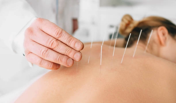 acupuncture treatments